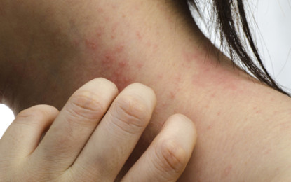 Infectiile repetate la nivelul pielii, un semnal de alarma tras de organism. Ce boli poate ascunde o infectie recidivanta